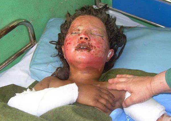 Une des victimes des bombes américaines dans un hôpital à Fararh city. Au moins 147 civils, parmi eux beaucoup de femmes et d’enfants, furent massacrés le 4 mai 2009 lors des frappes aériennes qui touchèrent les villages de Gerani et de Gangabad dans le district de Bala Baluk, Province de Farah, dans l’ouest de l’Afghanistan. Source : Wikimédia commons Une des victimes des bombes américaines dans un hôpital à Fararh city. Au moins 147 civils, parmi eux beaucoup de femmes et d’enfants, furent massacrés le 4 mai 2009 lors des frappes aériennes qui touchèrent les villages de Gerani et de Gangabad dans le district de Bala Baluk, Province de Farah, dans l’ouest de l’Afghanistan. Source : Wikimédia commons